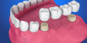 Read more about the article Dental Bridge: How You Can Get It Removed Or Recemented