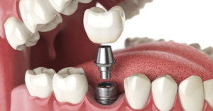 Read more about the article Are Dental Implants A Long-Term Solution For Missing Teeth?